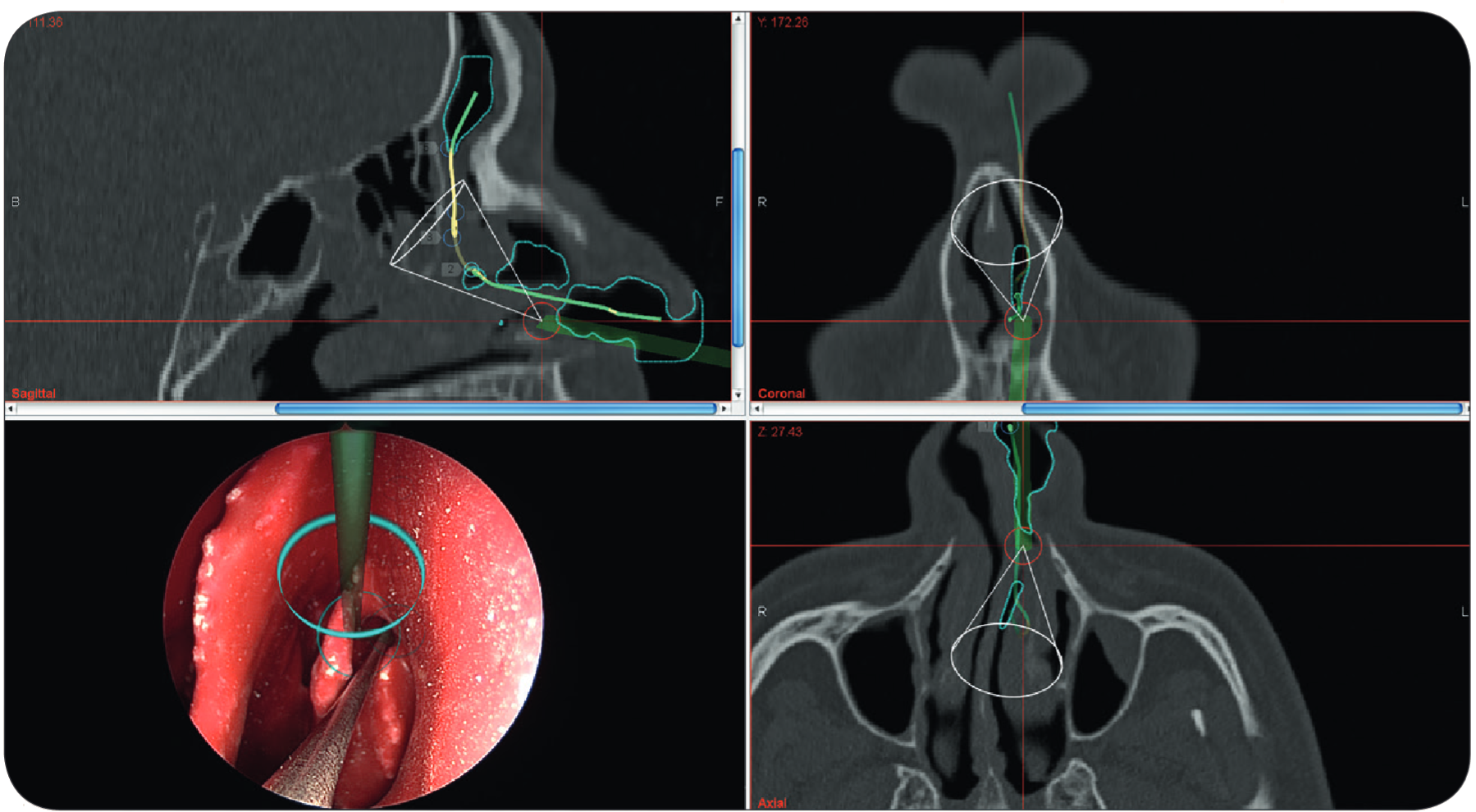 Navigation in ENT surgery