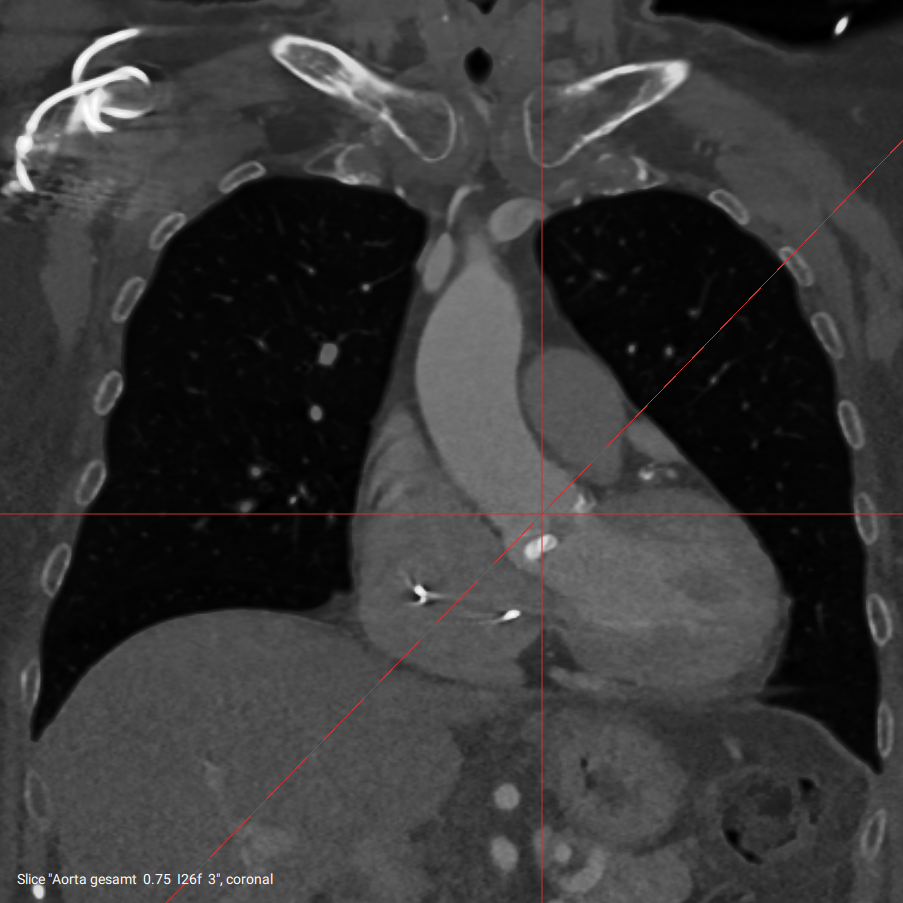 Home cardiac slice 1